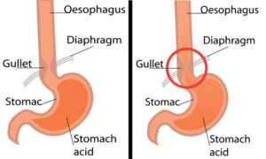 Gastroesophageal reflux desease diagram. Healthy and gerd stomach vector illustration