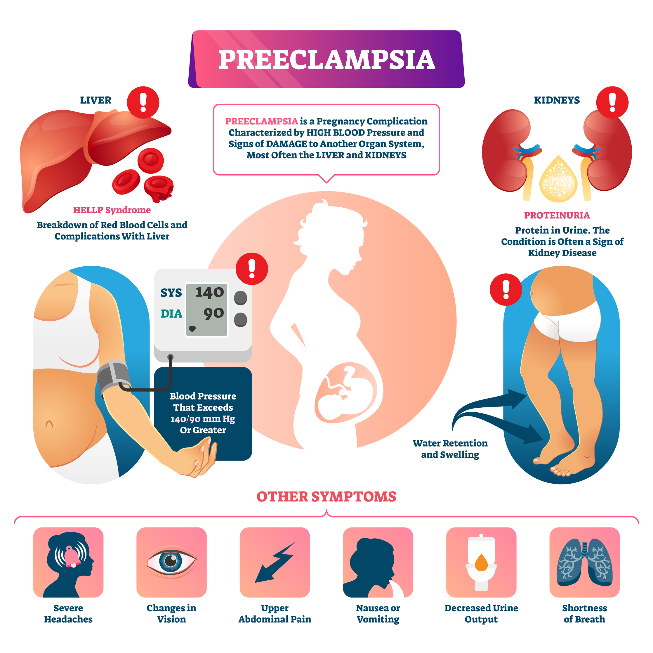 Preeclampsia vector illustration. Labeled pregnancy complication scheme.