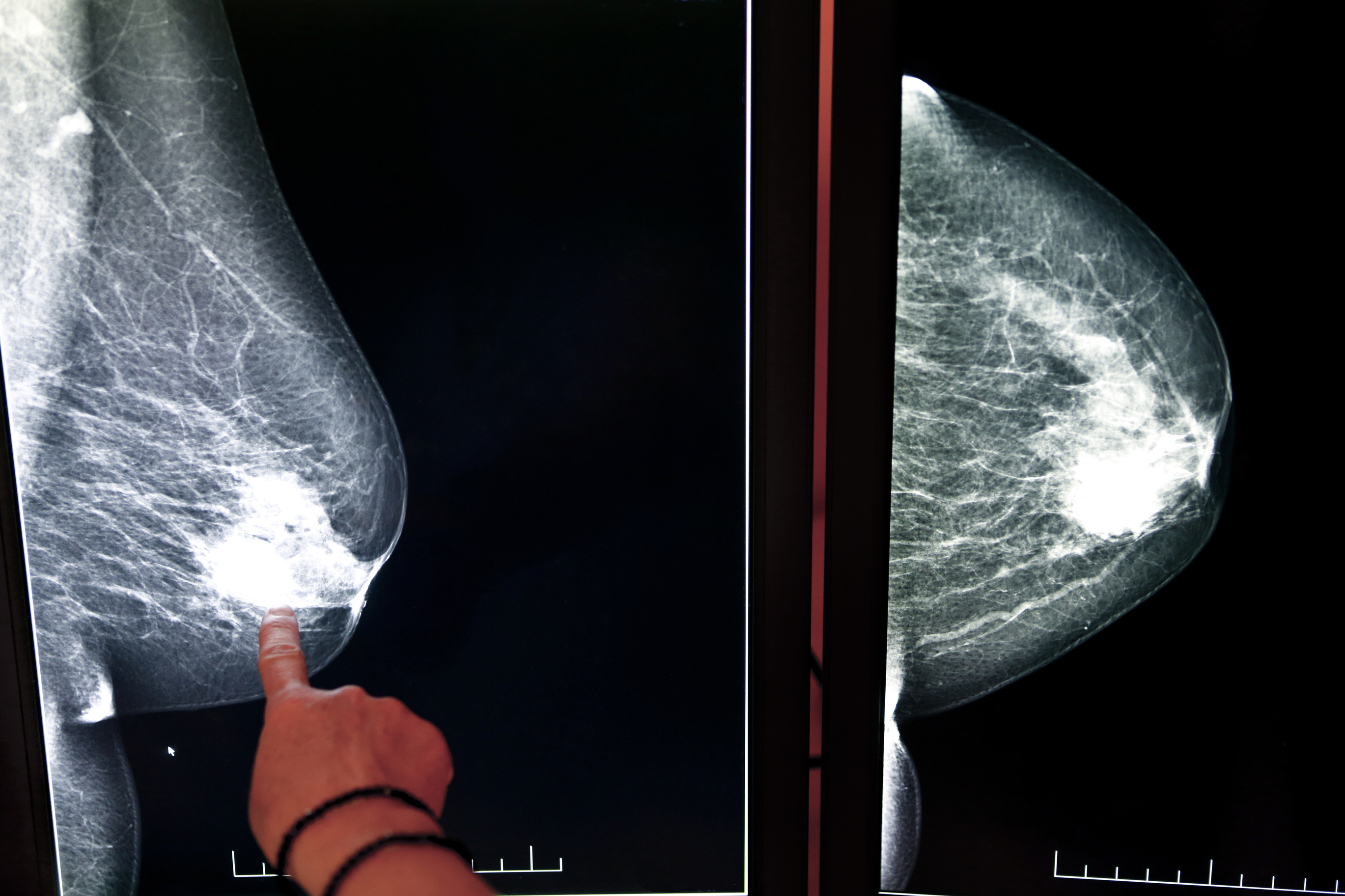 X-ray mammogram