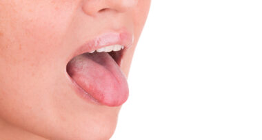tongue swelling - φλεγμονή της γλώσσας