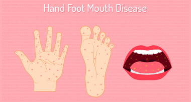 νόσος χεριών, ποδιών και στόματος