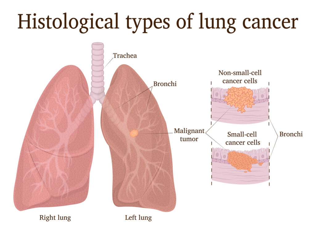 Illustration of lung cancer types