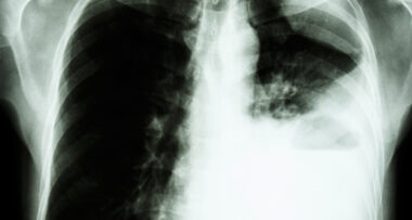 μη μικροκυτταρικός καρκίνος του πνεύμονα cover