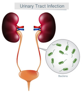 Urinary Tract Infection on White Background