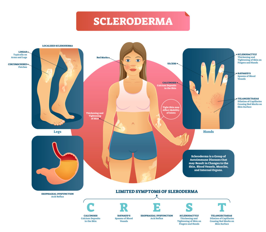 Scleroderma vector illustration. Autoimmune skin and blood disease.